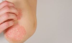 สังคัง หรือ กลากที่อวัยวะเพศ