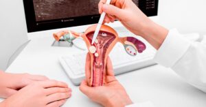 วินิจฉัยโรคเลือดออกผิดปกติทางช่องคลอด