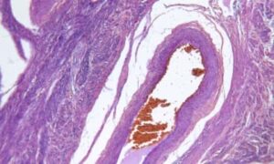 มะเร็งปากช่องคลอด (Vulvar Cancer)