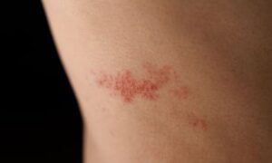 คันช่องคลอด จากโรคสะเก็ดเงิน